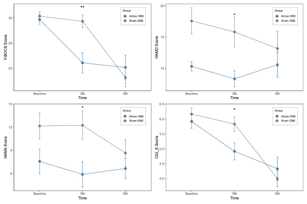 Line charts comparing the effects of Active DBS and Sham DBS on four scores (Y-BOCS, HAMD, HAMA, and CGI_S) over three time points: baseline, 3-month, and 6-month follow-up, with statistical significance indicated at certain points.