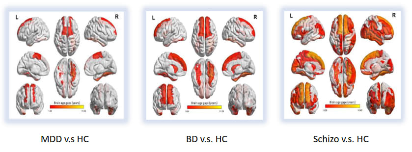 Figure1. brain age deviation among the schizophrenia, bipolar disorder (BD), major depressive disorder (MDD), and healthy controls (HC)