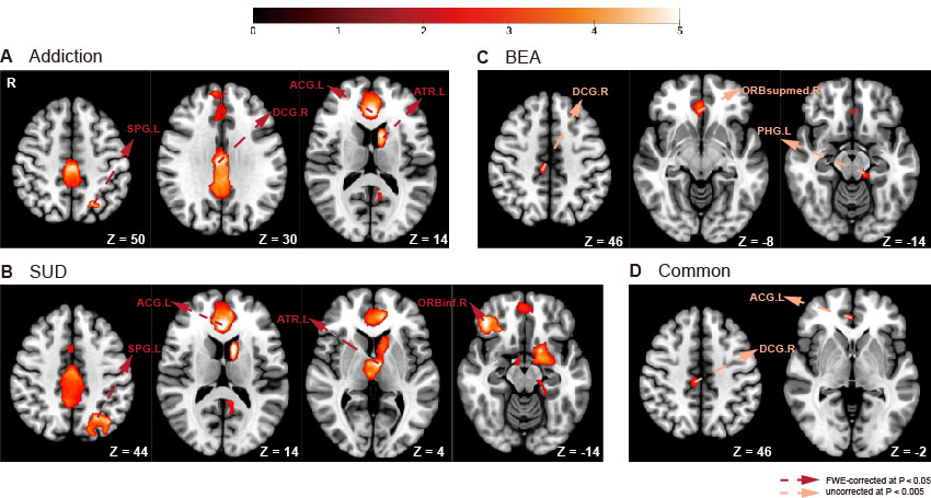 Coordinates indicating BOLD responses for addiction group vs comparison group in cue-reactivity tasks. Panel A shows brain regions with differential BOLD responses for all types of addiction compared to controls. Right median cingulate/paracingulate gyri, left anterior cingulate/paracingulate gyri, left anterior thalamic projections, and left superior parietal gyrus response higher BOLD active in addiction group compared with comparisons (FWE-corrected at P <0 .05). Panel B shows brain regions with differential BOLD responses for SUD group compared to controls. Left anterior cingulate/paracingulate gyri, left anterior thalamic projections, left superior parietal gyrus, and right inferior frontal gyrus, orbital part response higher BOLD active in SUD group compared with comparisons (FWE-corrected at P <0 .05). Panel C shows brain regions with differential BOLD responses for BEA group compared to controls. Right median cingulate/paracingulate gyri, right superior frontal gyrus, medial orbital, left parahippocampal gyrus responded higher activation compared to controls (uncorrected at P < 0.005). Panel D shows the common coordinates indicating BOLD responses compared to control group in both SUD group and BEA group in cue-reactivity tasks. Right median cingulate/paracingulate gyri, left anterior cingulate/paracingulate gyri responded higher activation compared to controls in both SUD group and BEA group (uncorrected at P < 0.005). SPG.L, left superior parietal gyrus; DCG.R, right median cingulate/paracingulate gyri; ACG.L, left anterior cingulate/paracingulate gyri; ATR.L, left anterior thalamic projections; ORBinf.R, right inferior frontal gyrus, orbital part; ORBsupmed.R, right superior frontal gyrus, medial orbital; PHG.L, left parahippocampal gyrus.