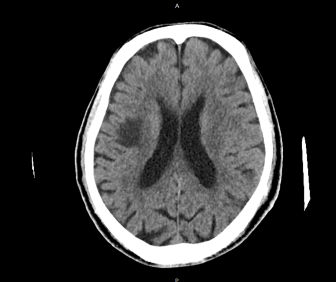 A hypodense lesion in the right thalamus, identified on computed tomography, raises suspicion for a focal ischemic change.